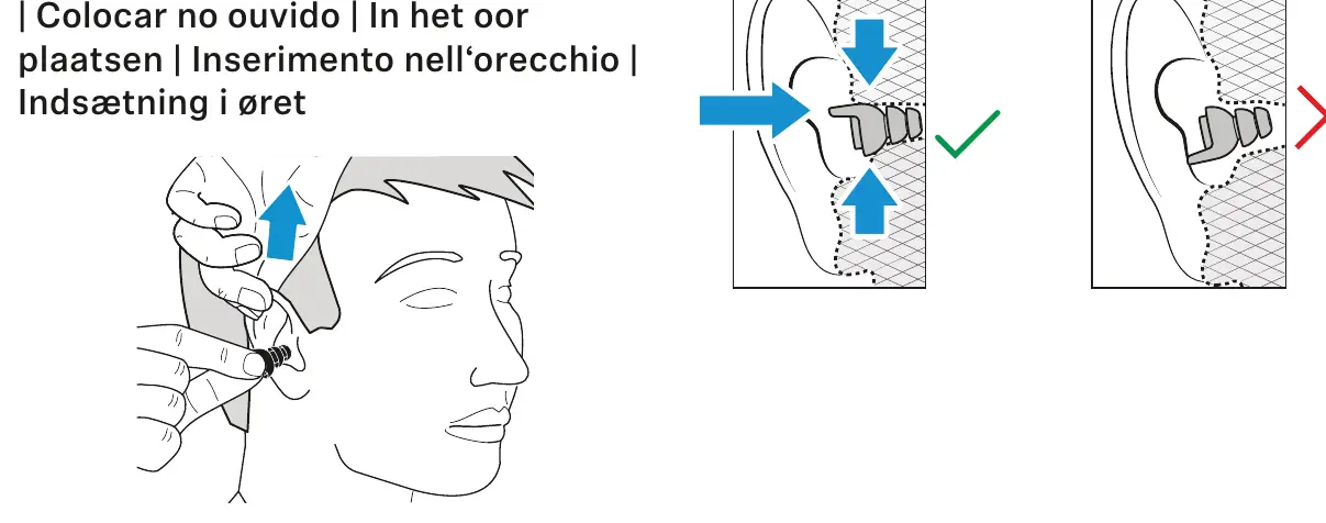 Korrekte Technik zum Einsetzen der Ohrstöpsel